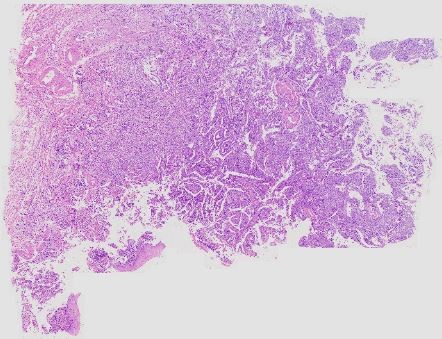 Uterine cancer-91